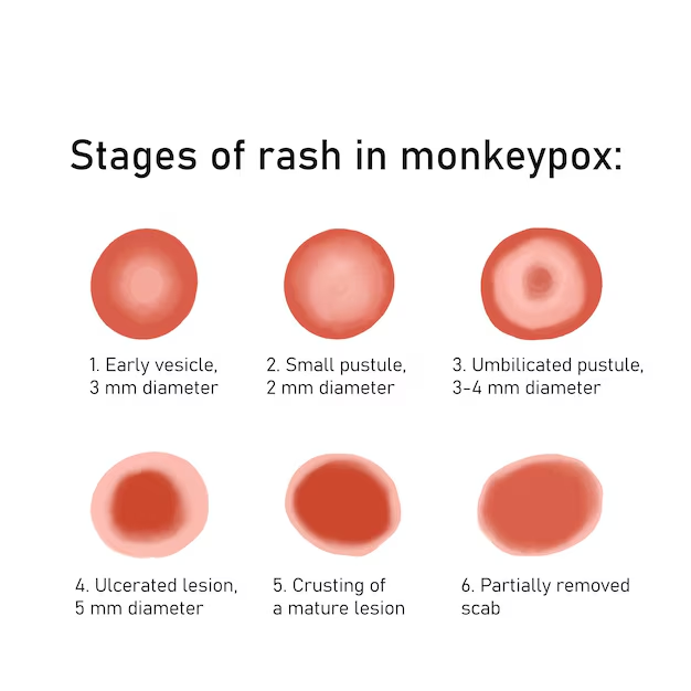 monkeypox rash